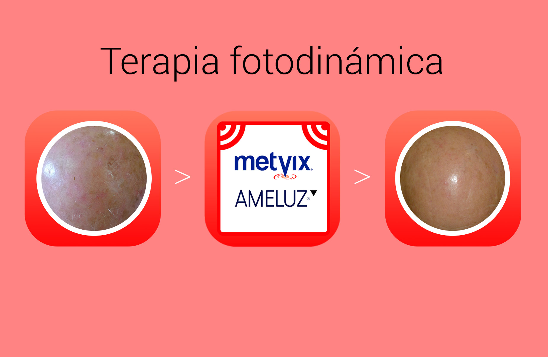 Terapia Fotodinámica