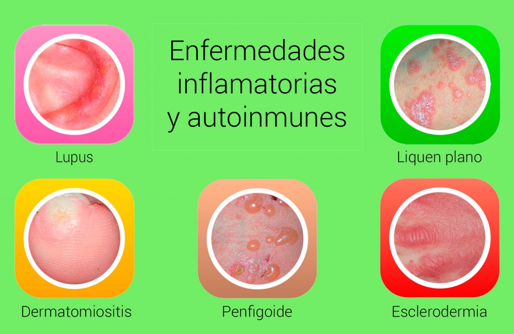 Enfermedades inflamatorias y autoinmunes