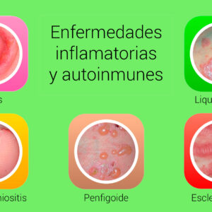Enfermedades inflamatorias y autoinmunes