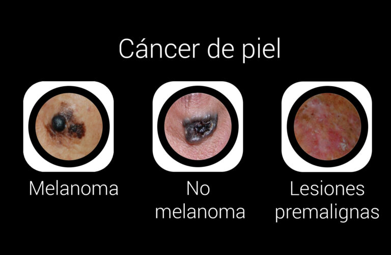 Melanoma