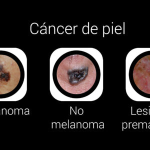 Cáncer de piel