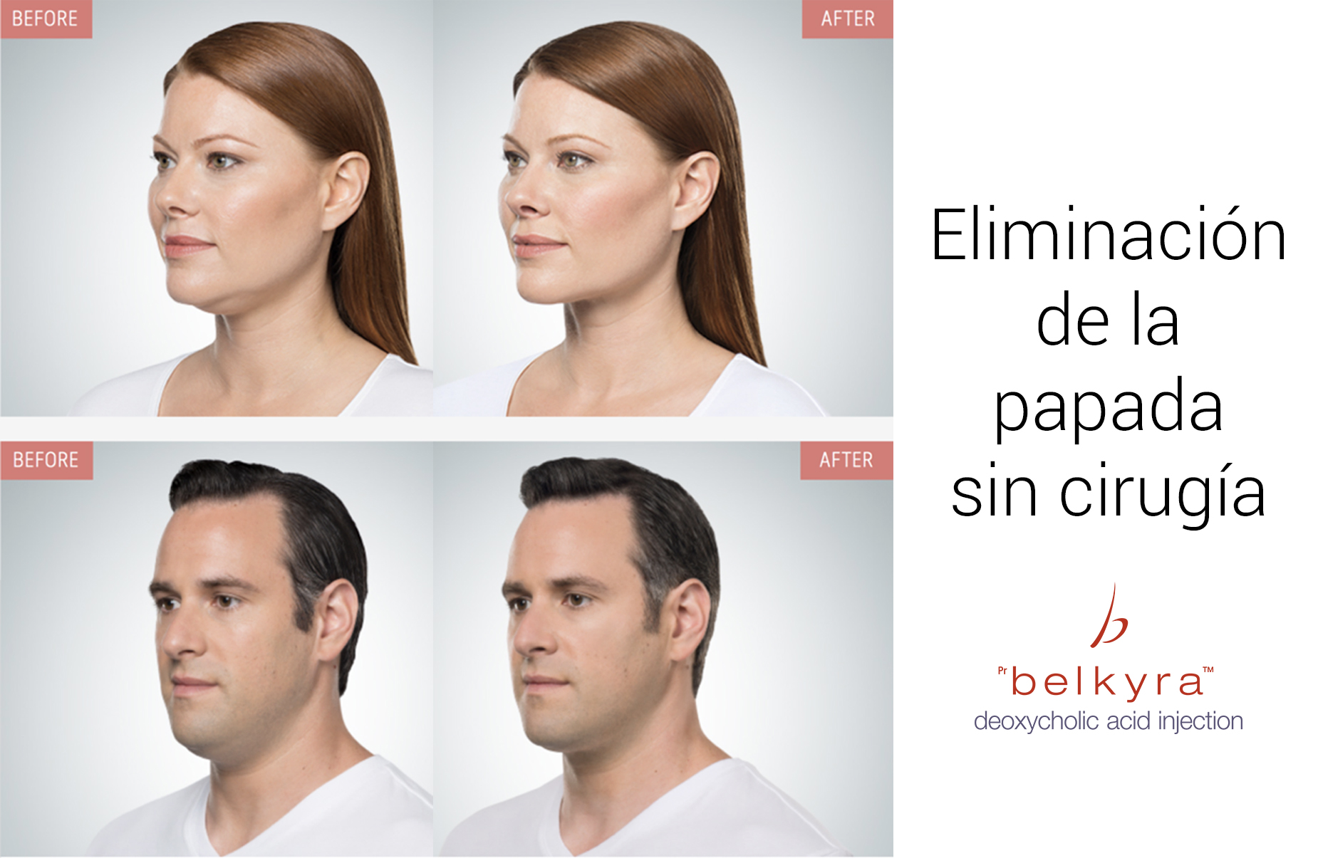 Belkyra: eliminación de la grasa submentonia (papada) sin cirugía - Lidia  Pérez dermatólogos