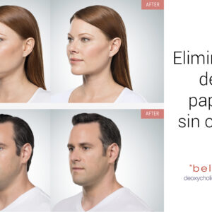 Belkyra eliminaBelkyra elimina papada sin cirugía papada sin cirugía