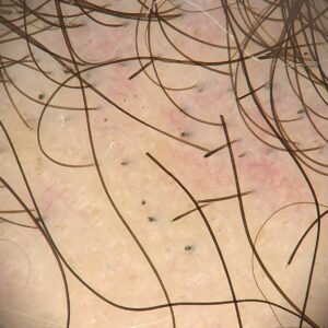 alopecia areata
